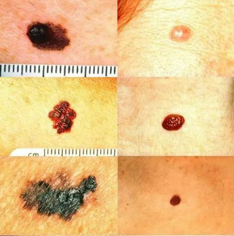 Nyrekræft melanom