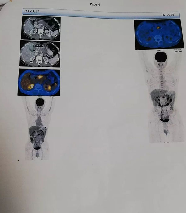 alaisan akàn pancreatic ajo1