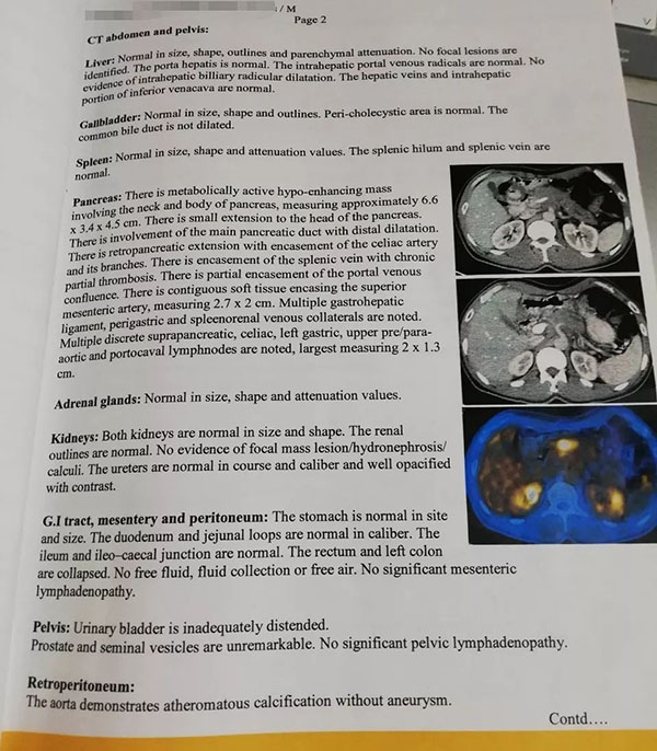 pancreatic cancer murwere akafamba2