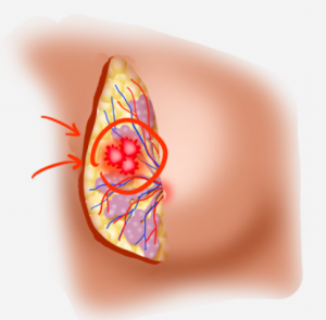 乳腺 结节 1