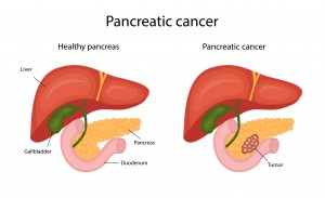 pancreatic cancer. infographics. vector illustration in cartoon style.
